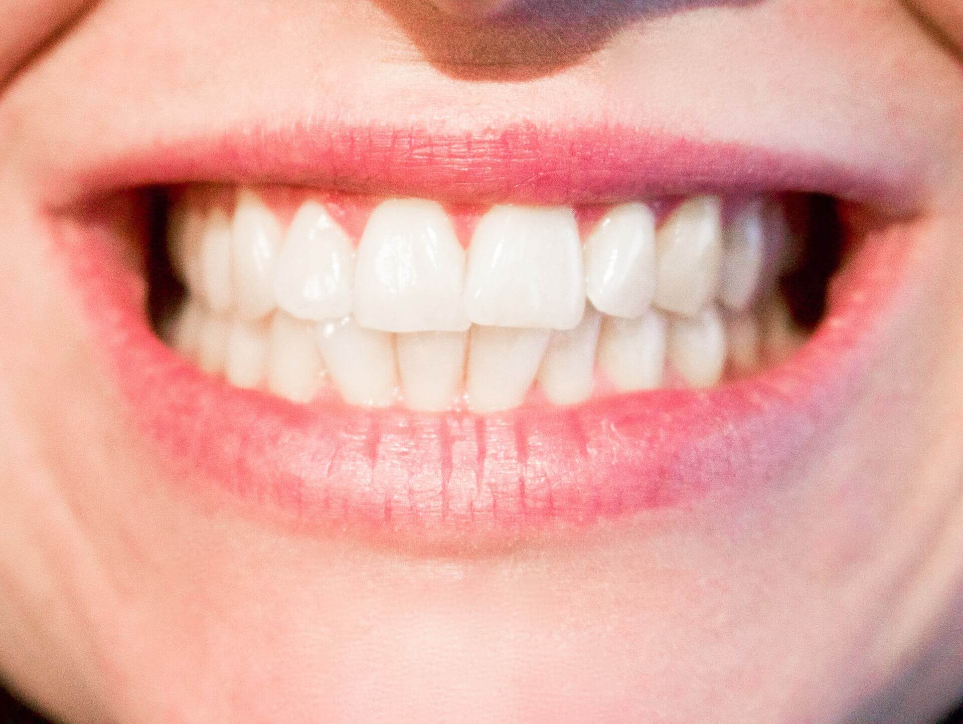 Guest Post: 7 Reasons Dental Sealants Are A Good Idea