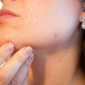 Hormonal Acne Treatments