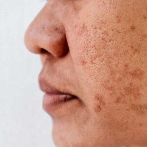 Melasma %E2%80%93 Management And Interventions Guide 300x300