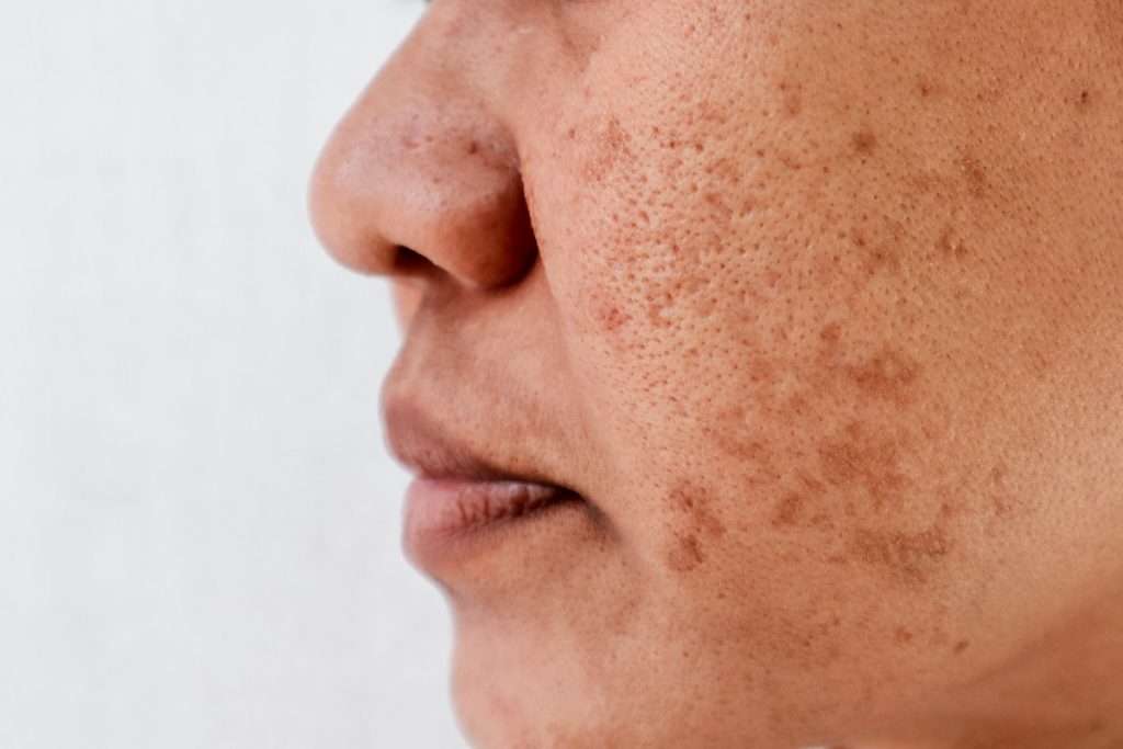 Melasma – Management and Interventions Guide