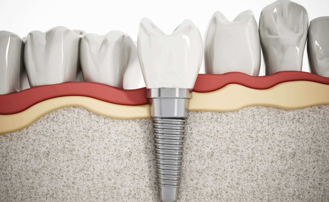 How Much Are Dental Implants Near Me, And Other FAQs
