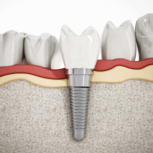 How Much Are Dental Implants