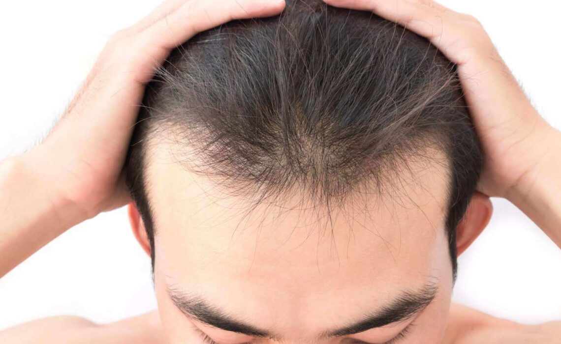 Reasons For Male Hair Loss