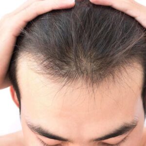 Reasons For Male Hair Loss