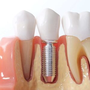 Dental Implants Can Boost Your Confidence