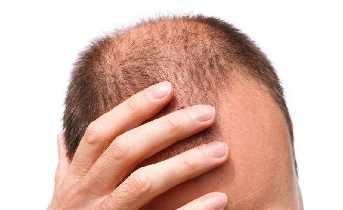 The Different Types Of Hair Loss: A Simple Guide