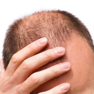 Different Types Of Hair Loss