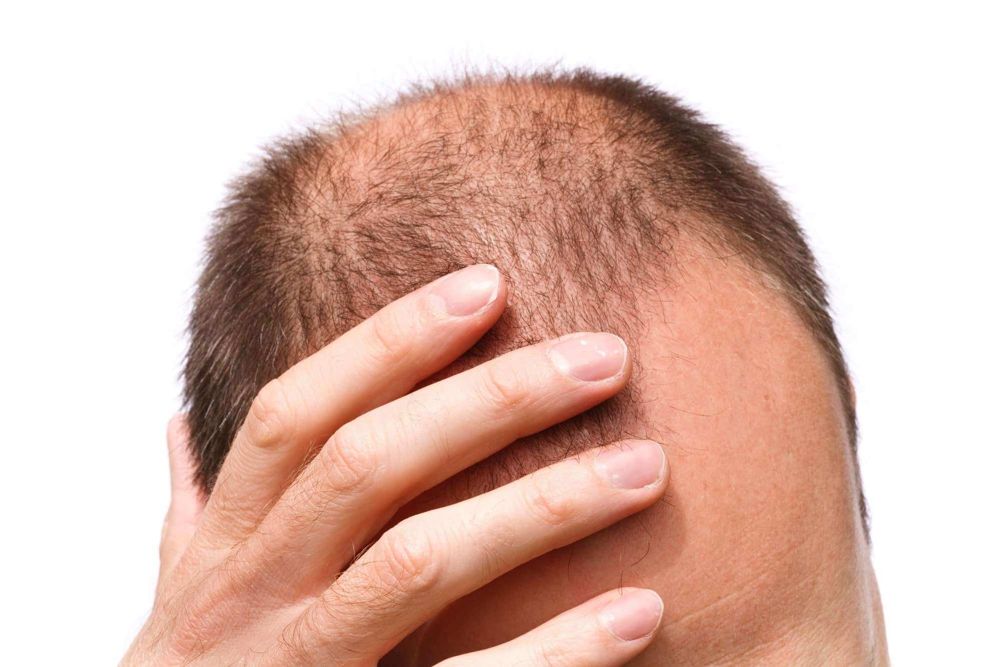 The Different Types Of Hair Loss: A Simple Guide | Suntrics
