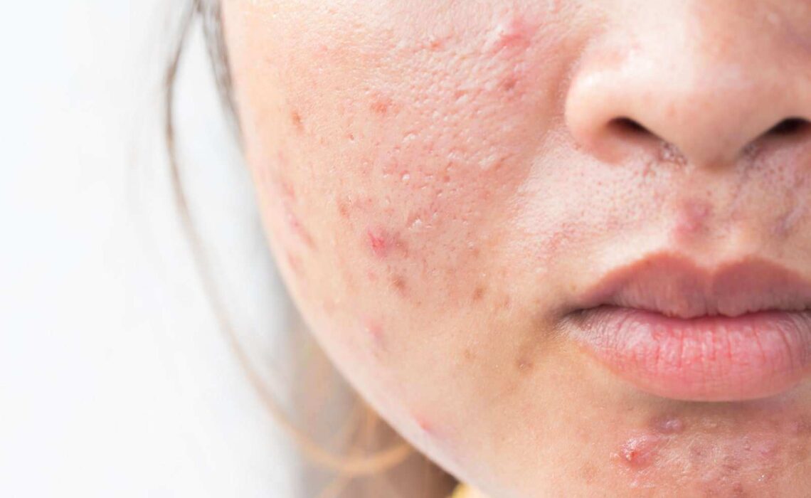 What Are The Different Types Of Acne Scars?
