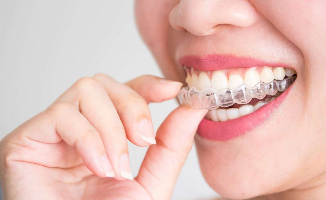 Invisalign Vs Braces: The Differences You Need To Know