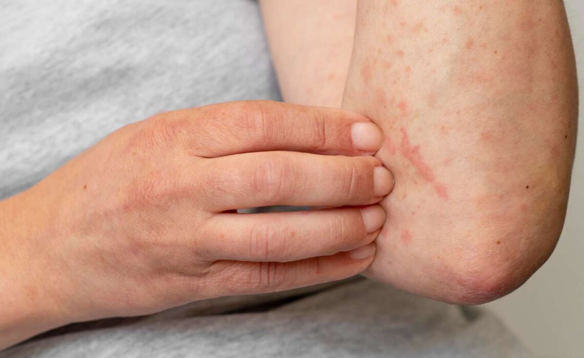 10 Things To Do To Prevent Eczema To Flare-up