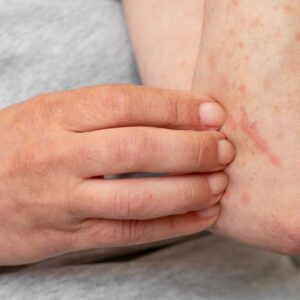 Things To Do To Prevent Eczema