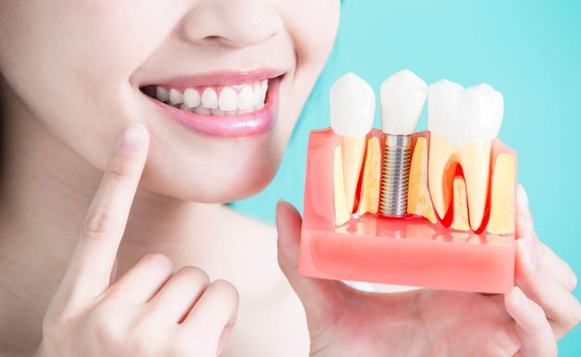 Is A Dental Implant Procedure Safe? Learn Everything About It
