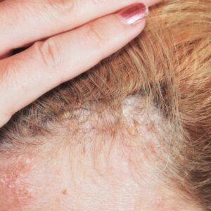 Guide To Scalp Psoriasis