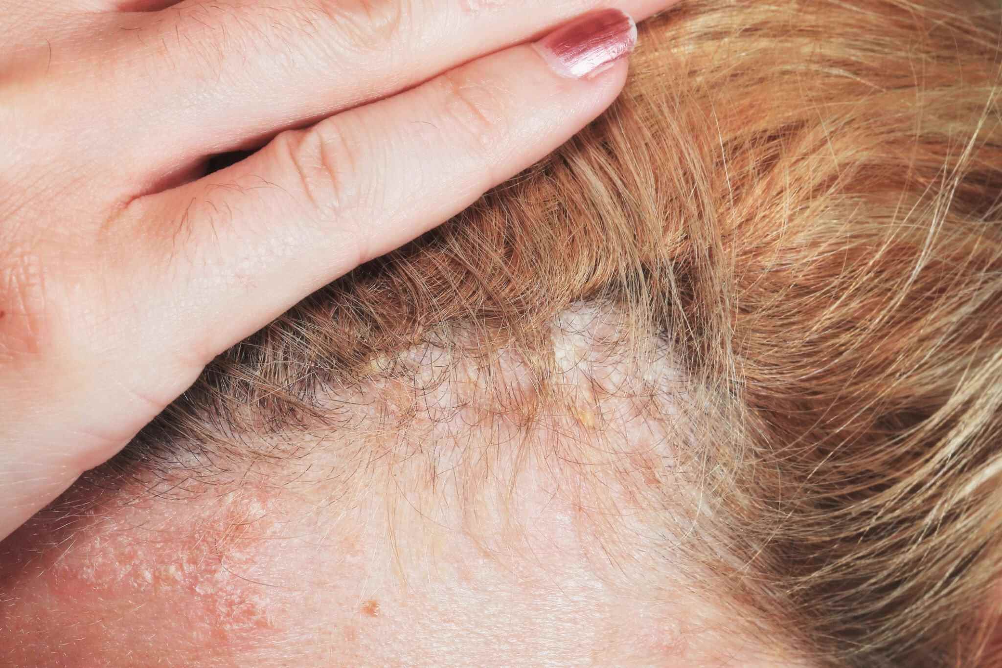 Guide To Scalp Psoriasis 