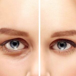 Treatments To Fix Eye Wrinkles