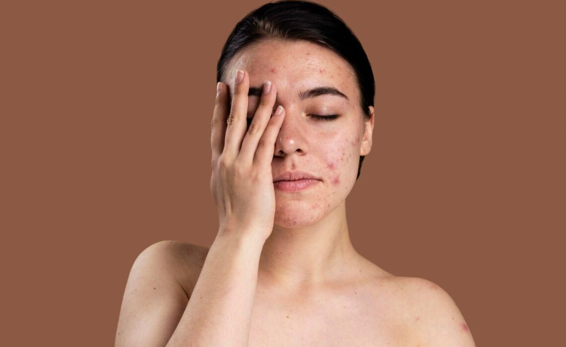 Battling Acne Scars and Blemishes? Steps to Heal and Improve Skin Texture