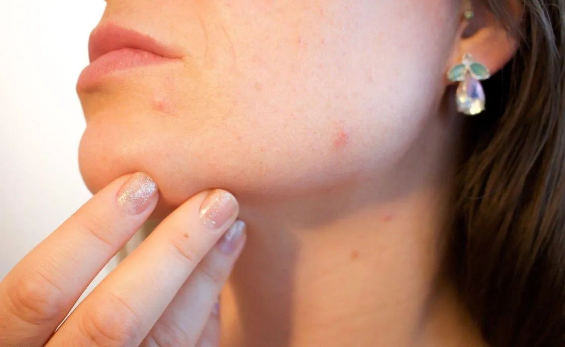 Hormonal Acne Treatments