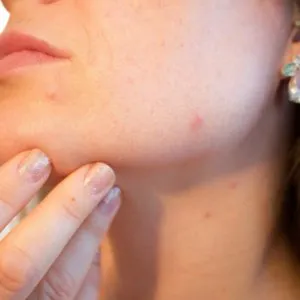 Hormonal Acne Treatments