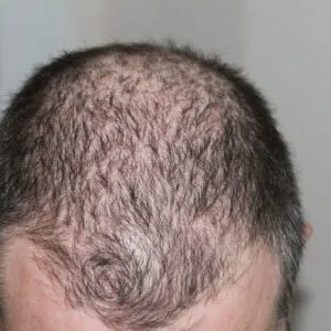 Facts About Hair Transplant