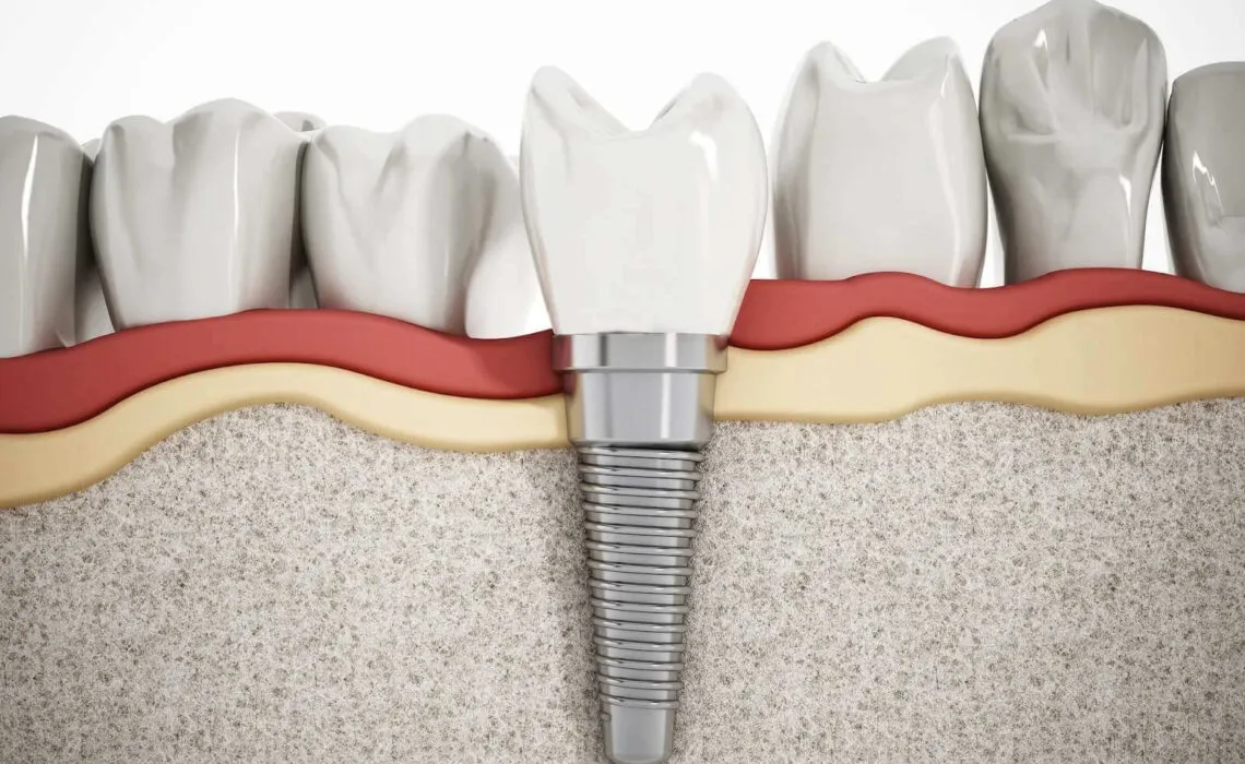 How Much Are Dental Implants