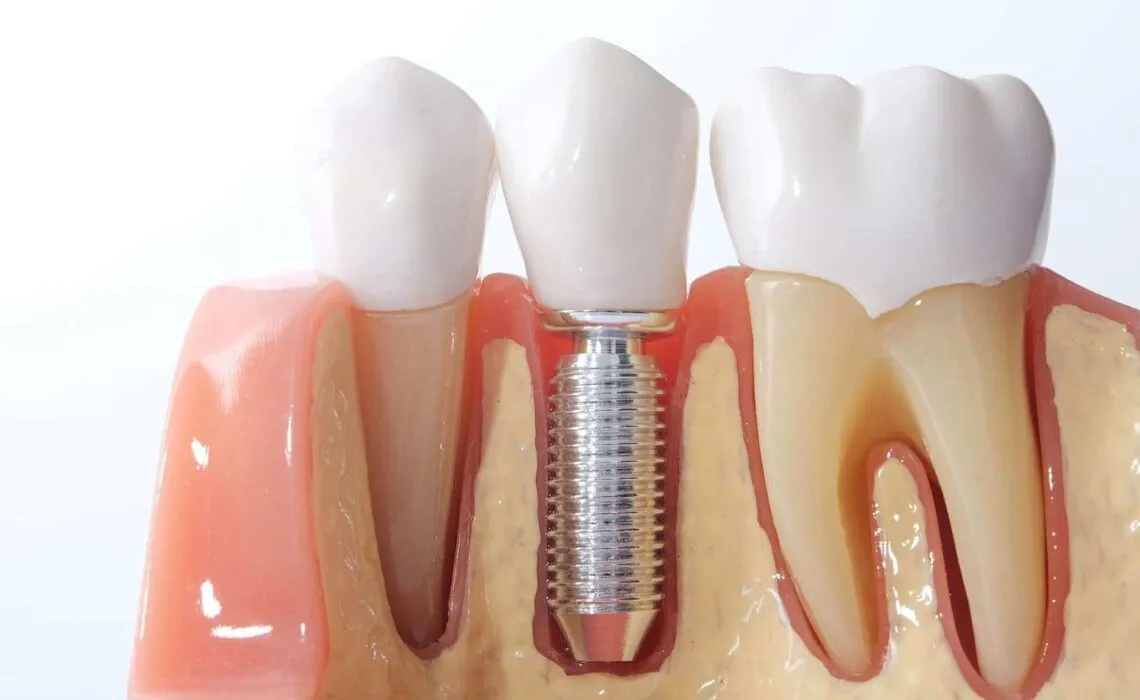 Dental Implants Can Boost Your Confidence