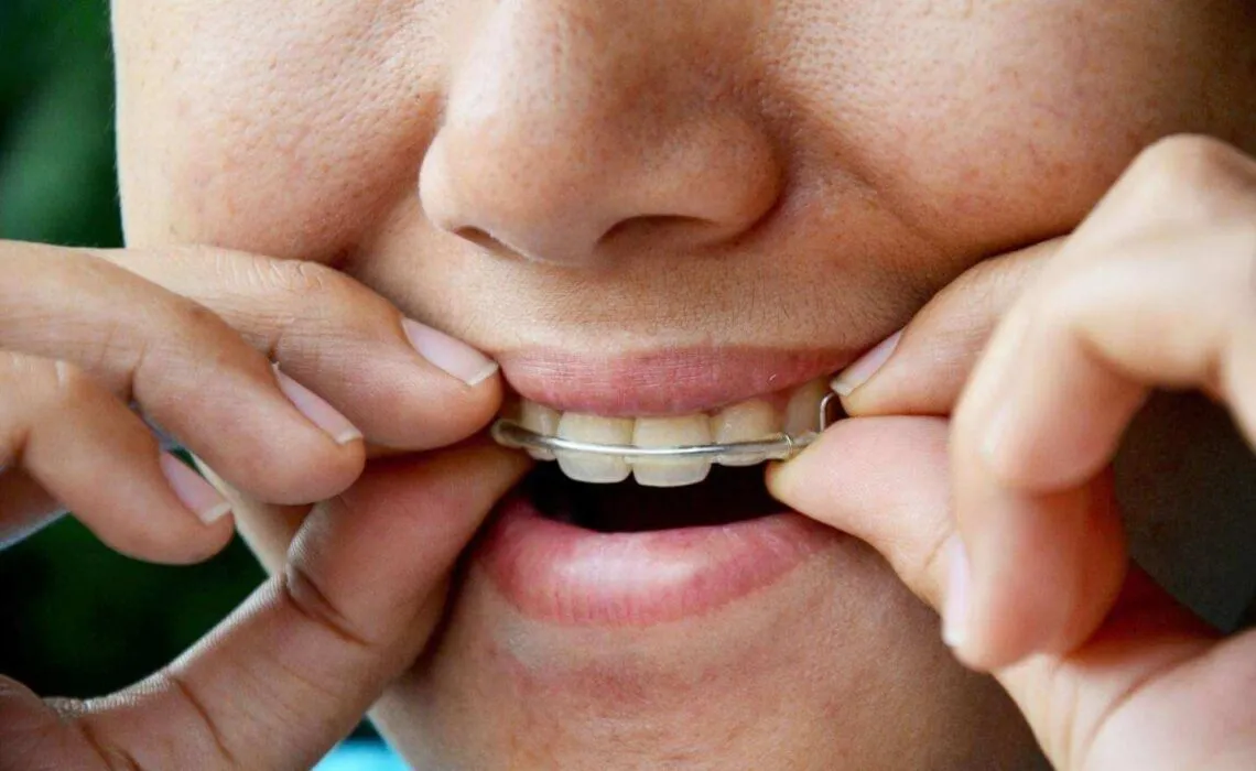 Retainer Doesn’t Fit Anymore