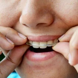 Retainer Doesn’t Fit Anymore