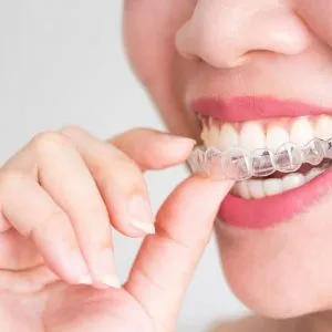 Invisalign Vs Braces