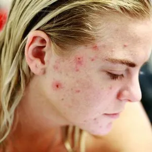 Facial Scars Types