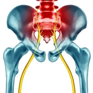 Sciatica Surgery