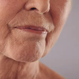 How To Reduce Neck Wrinkles