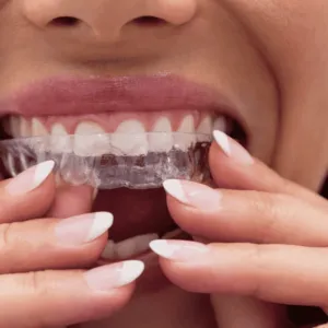 Adult Invisible Braces