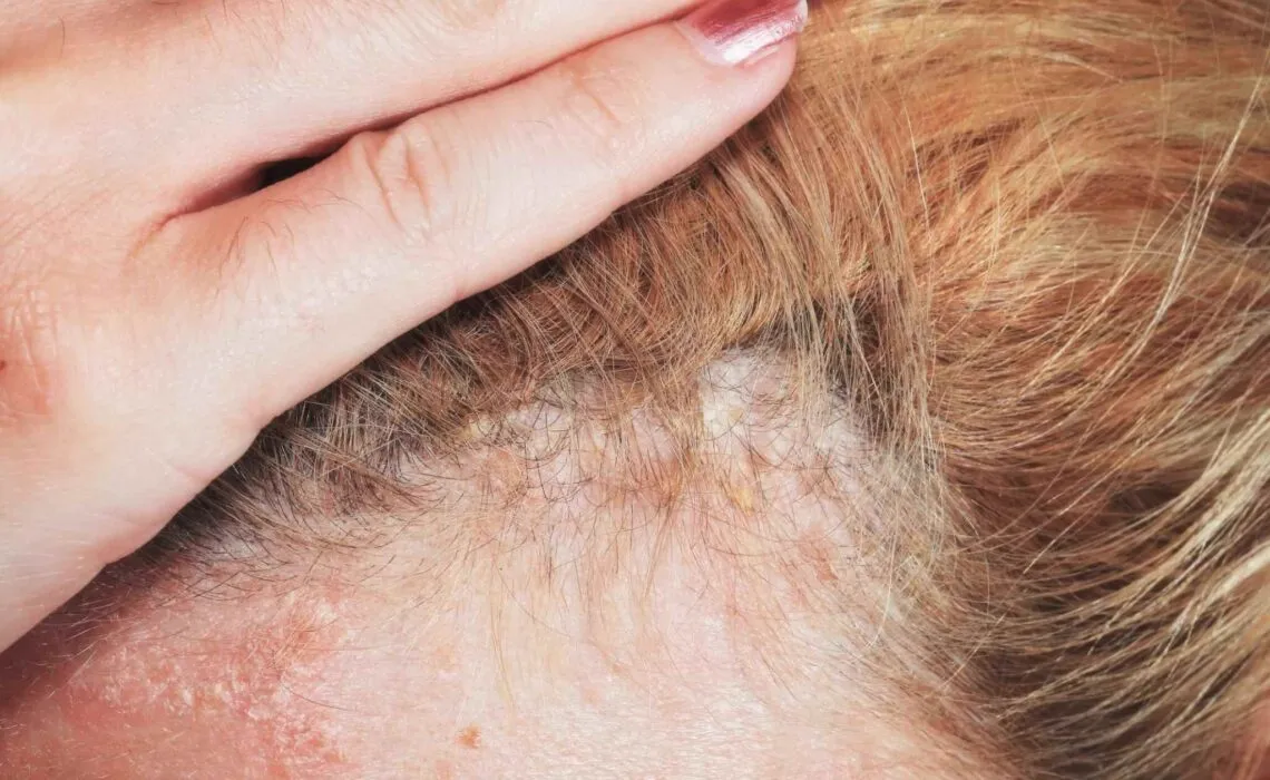 Guide To Scalp Psoriasis