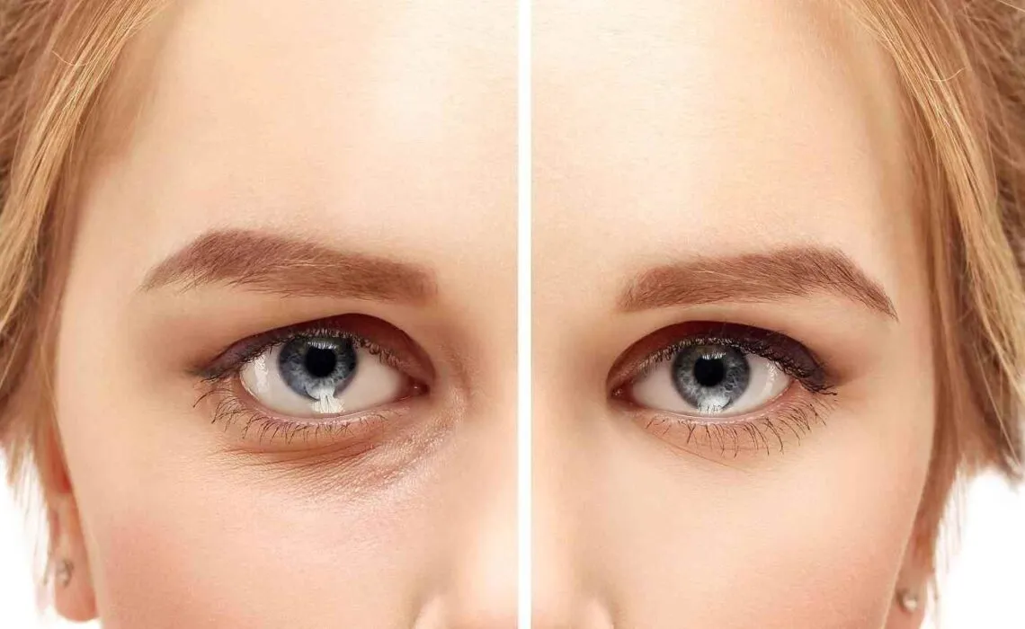 Treatments To Fix Eye Wrinkles