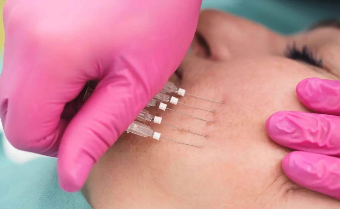 Customized PDO Thread Lifts