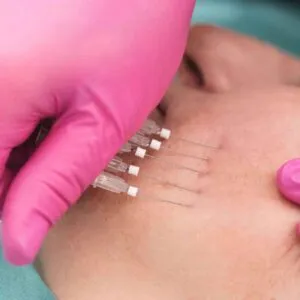 Customized PDO Thread Lifts